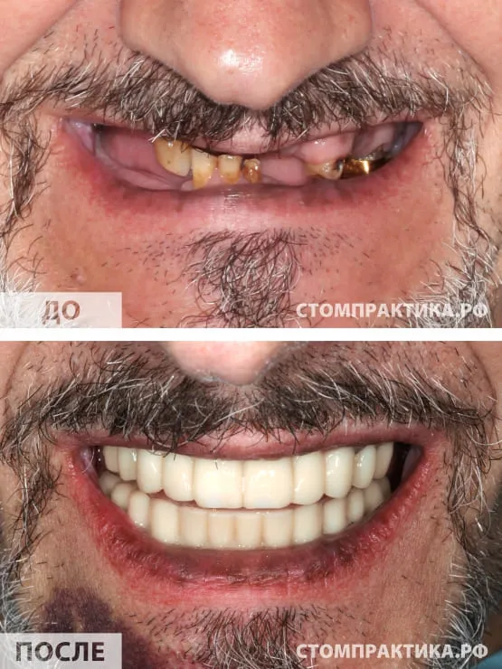 Фотография до после имплантации