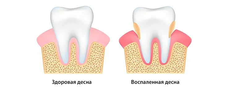 Сравнение здоровой десны и десны с воспалением