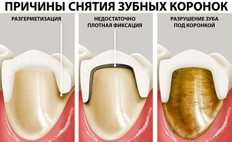На фото показаны основные случаи, когда требуется снятие коронки когда требуется снятие коронки