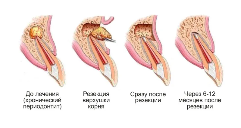 Проведение резекции верхушки корня зуба Резекция зуба