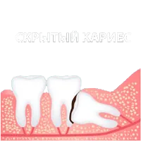 karies_02112020.png
