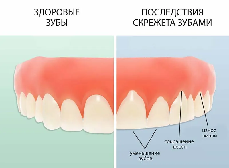 Последствия стираемости зубов стираемость зубов
