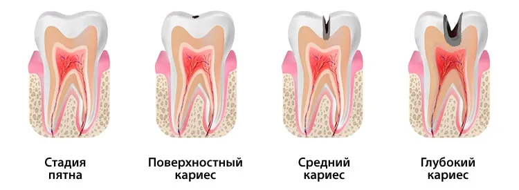 Виды кариеса по степени поражения Виды кариеса по степени поражения