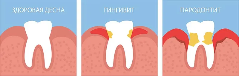 заболевания десен