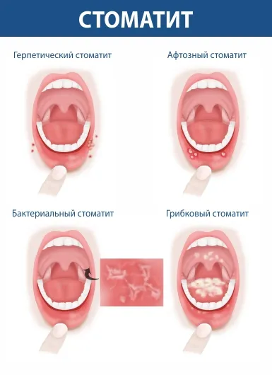 Стоматит на десне. Лечение