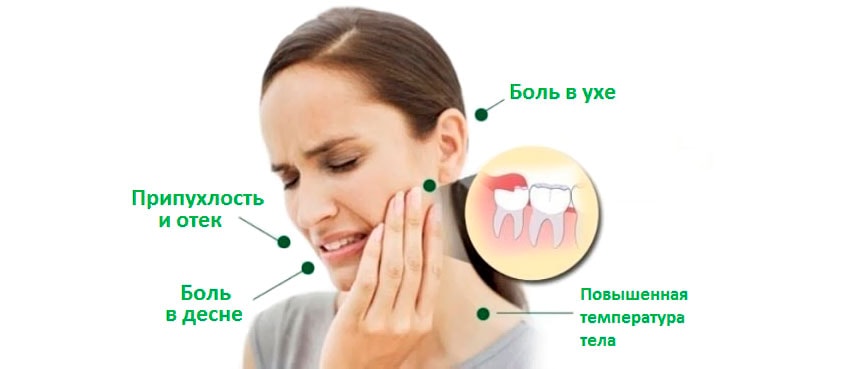 Симптомы прорезывания зубов мудрости