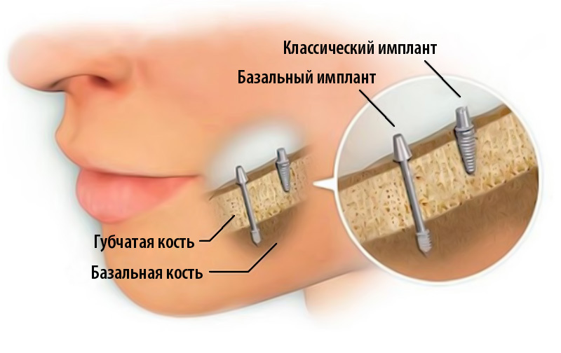 Лечение зуба в Челябинске