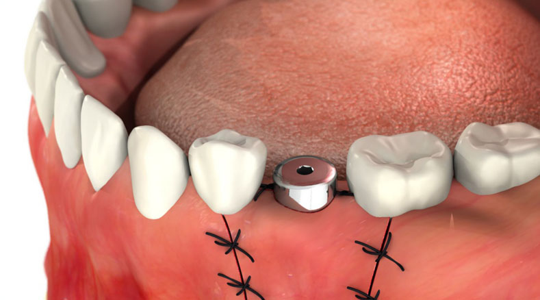 Сятие швов после Имплантации зуба