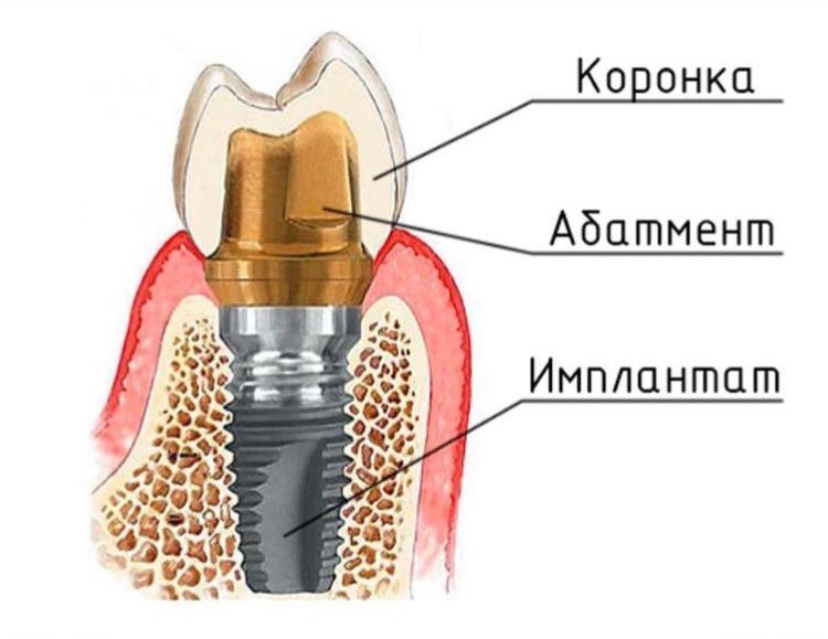 схематическое изображение импланта