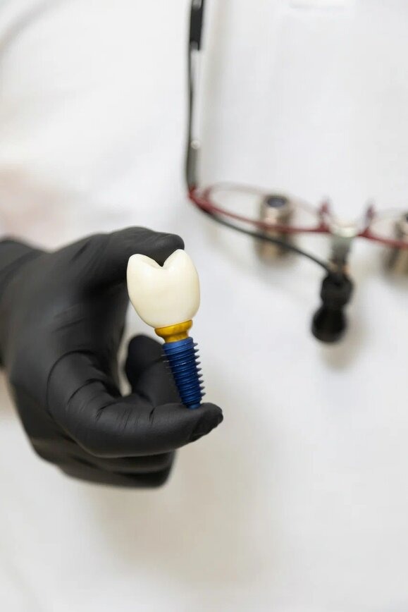 Стоматолог держит модель зубного импланта