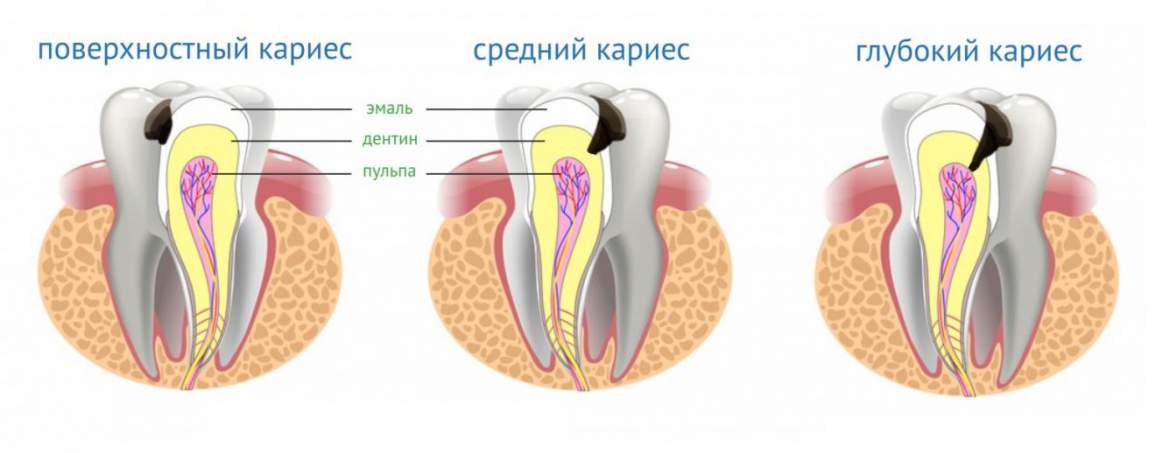 стадии Кариеса зуба