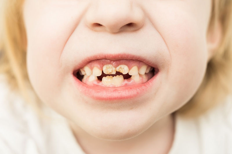 Портятся зубы у ребенка