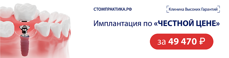  Имплантация «Готовый зуб» за 49 470 рублей